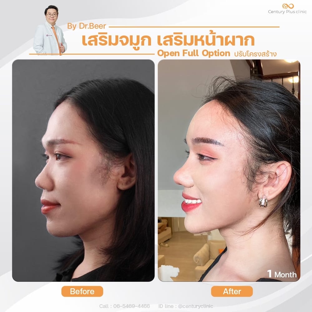 รีวิว เสริมจมูก #1376 , Century Clinic Thailand เสริมจมูก 2#1376