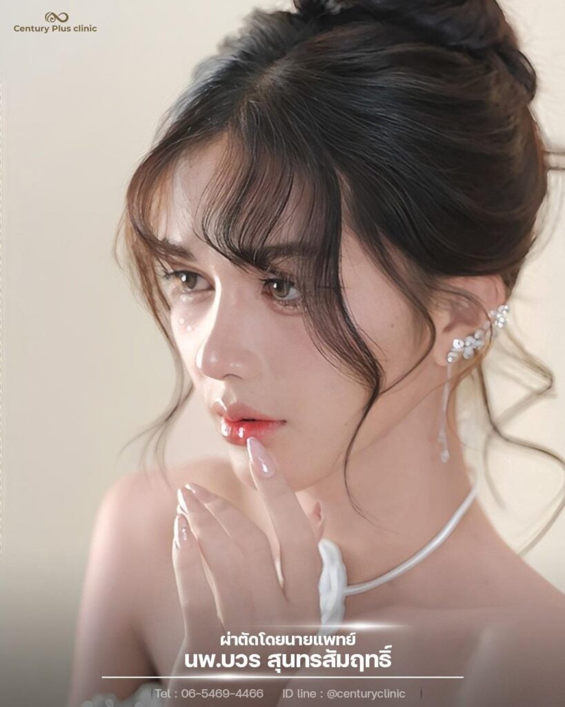 รีวิว เสริมจมูก #1384 , Century Clinic Thailand เสริมจมูก 2#1384