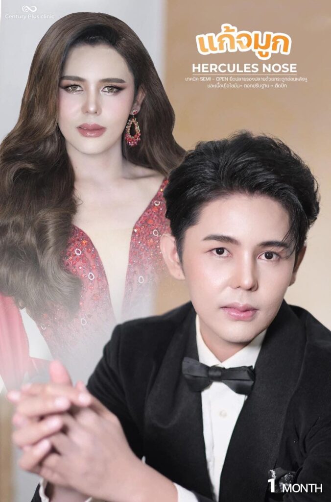แก้จมูก 1#1398