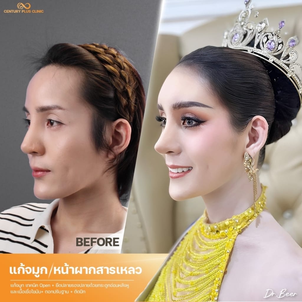 แก้จมูก 1#1406