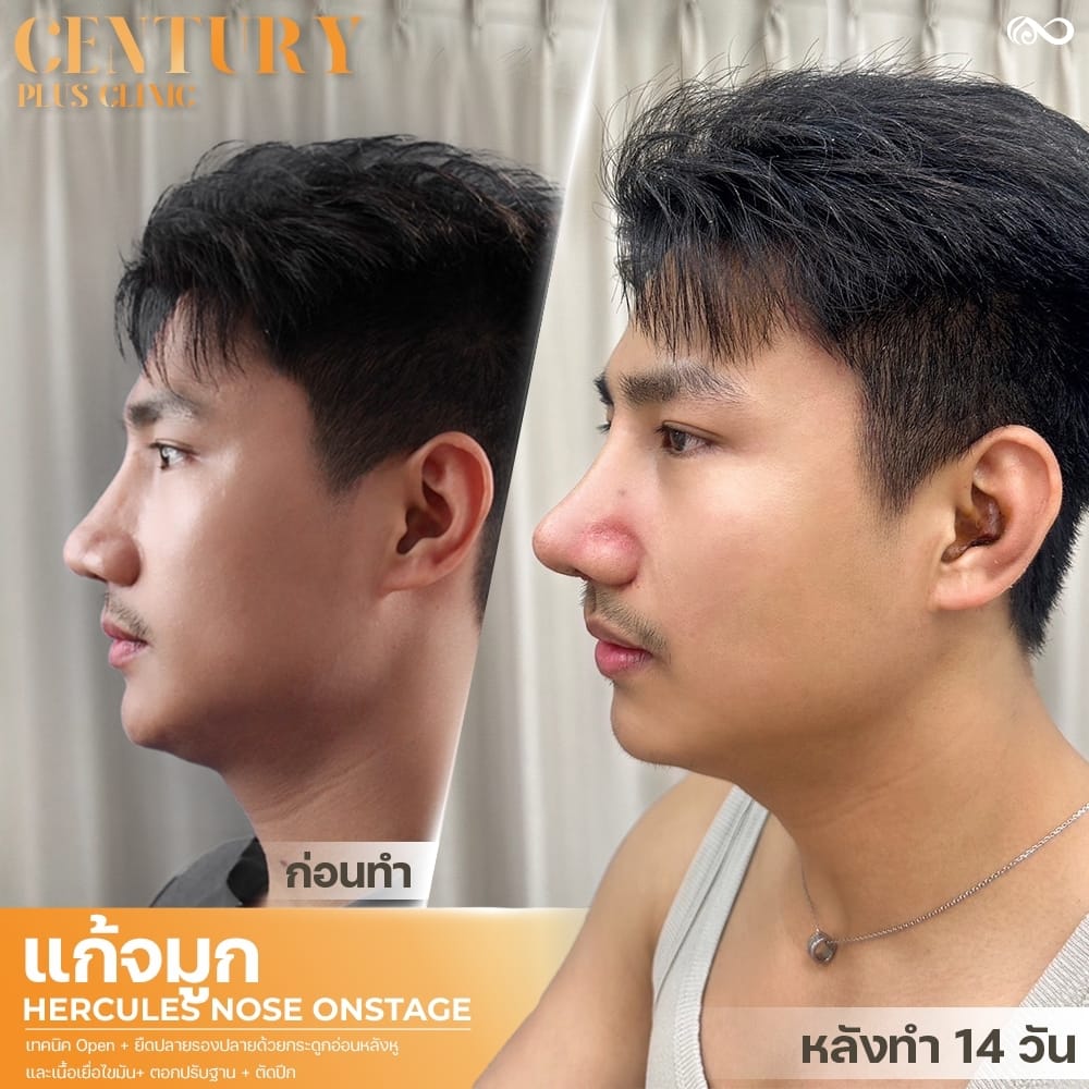 แก้จมูก #1395