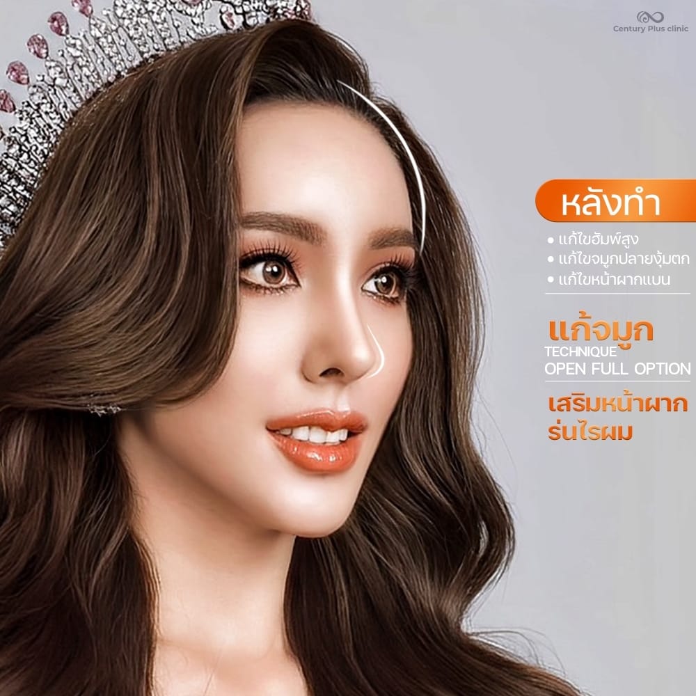 แก้จมูก 2#1385