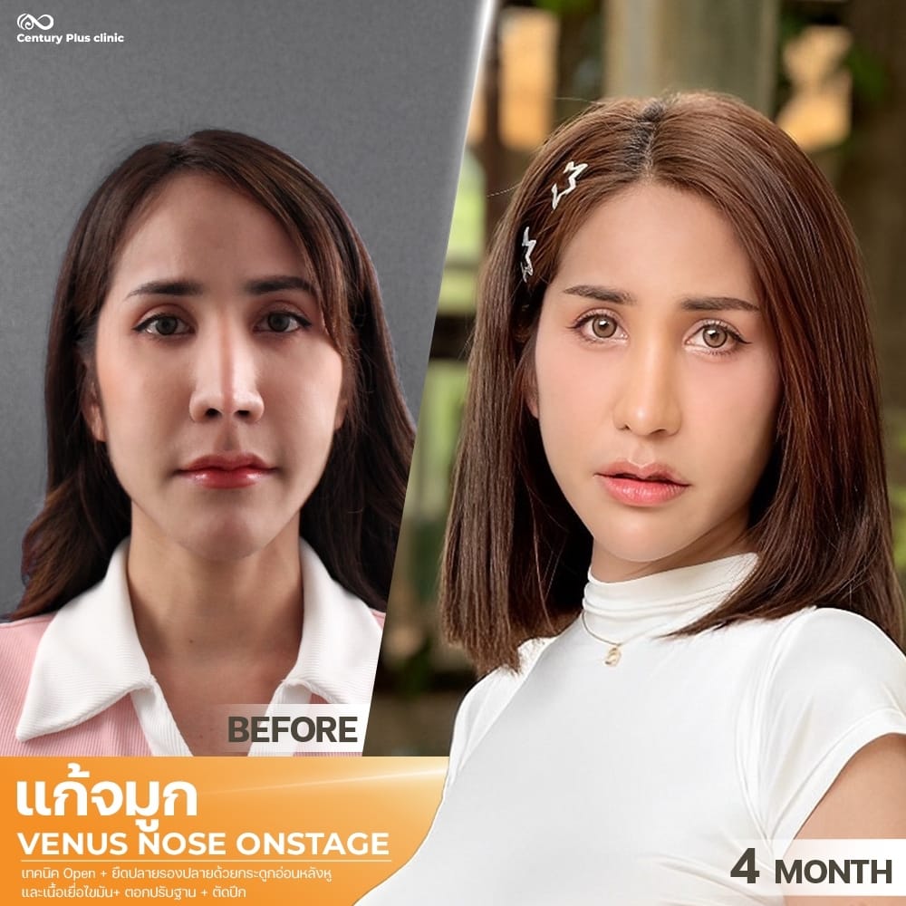 แก้จมูก 2#1403