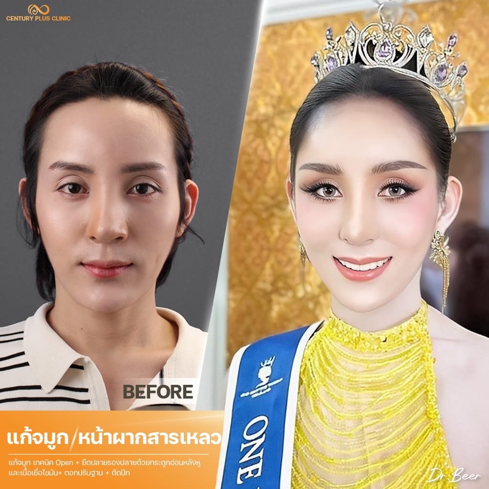 แก้จมูก 2#1406